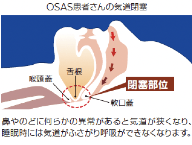 OSAS患者さんの気道閉塞