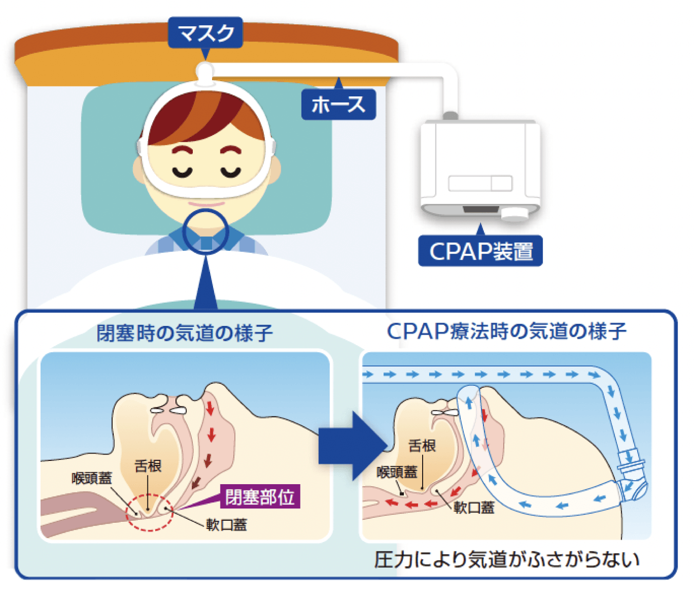 CPAP(持続陽圧呼吸療法) 装置による治療